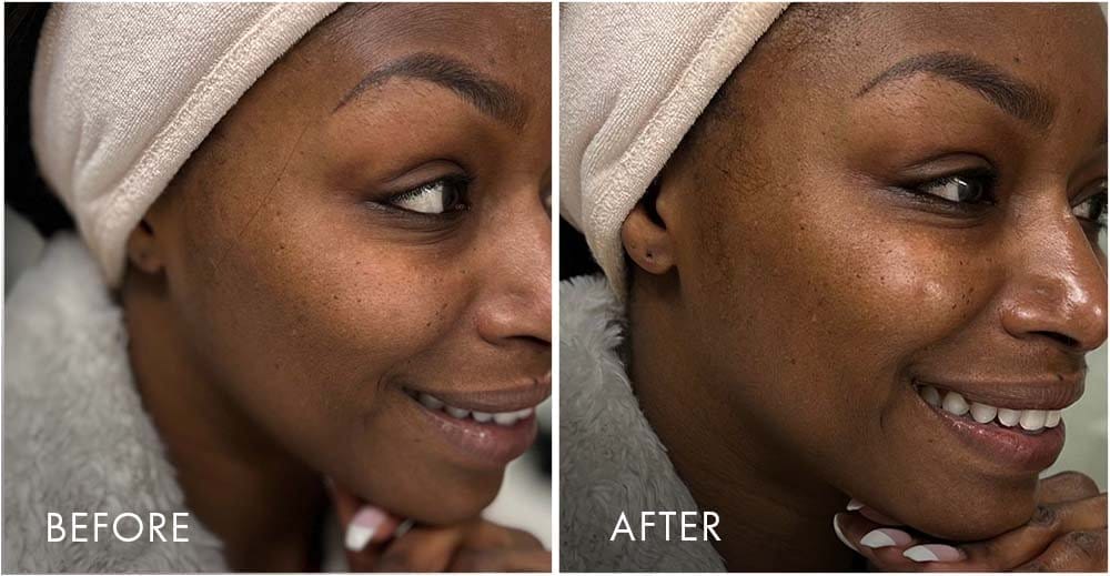 Before & After Result | EXFOLIATING ENZYME CLEANSER