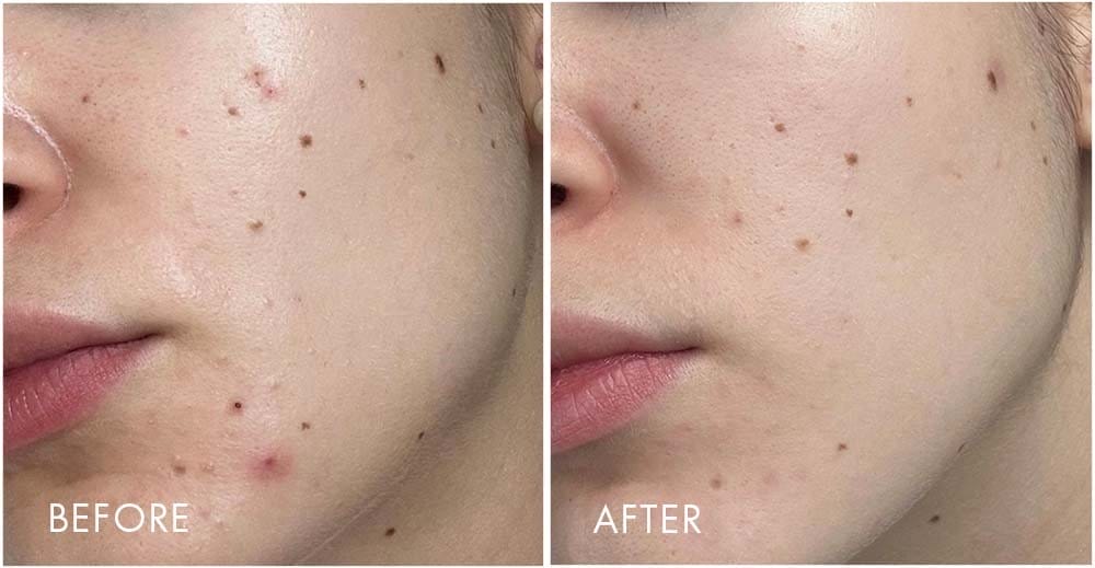 Before & After Result | EXFOLIATING ENZYME CLEANSER