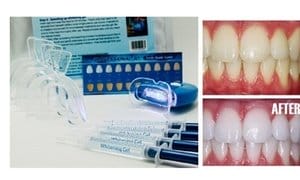 Home Teeth Whitening 3D System and Free Remineralization Gel