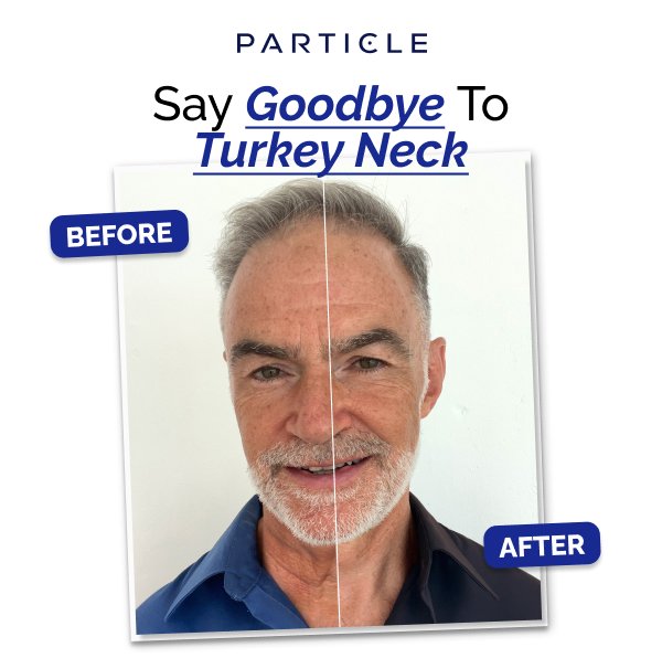 Say Goodbye to turkey neck