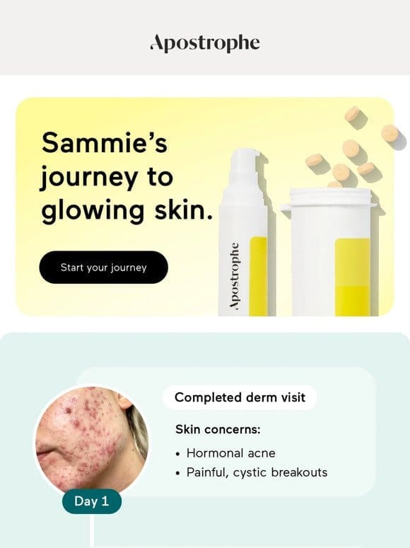 How Sammie cleared her hormonal acne. ❤️‍